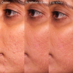 Caudalie Vinopure Akne Karşıtı Salisilik Serum 30 ml - 5